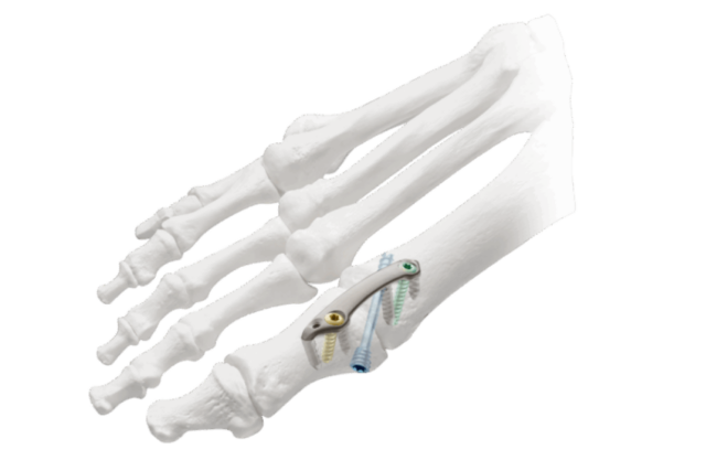 Medical illustration of a foot skeleton showing orthopedic screws and plates for surgical fixation.