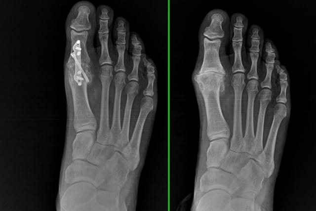 Side-by-side X-ray images of a human foot showing a hallux valgus deformity before surgery (right) and the successful realignment after a Lapiplasty 3D Bunion Correction procedure with implanted plates and screws (left).