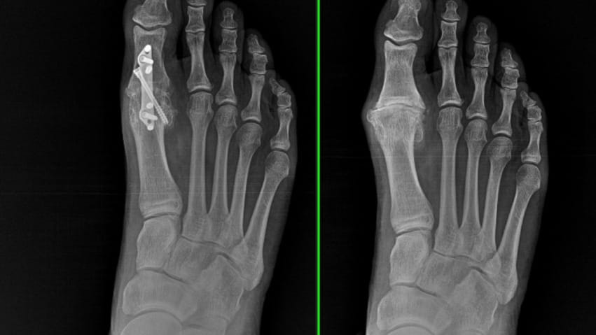 Side-by-side X-ray images of a human foot showing a hallux valgus deformity before surgery (right) and the successful realignment after a Lapiplasty 3D Bunion Correction procedure with implanted plates and screws (left).