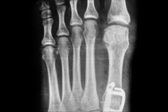 X-ray of a foot showing a small rectangular electronic device attached to one of the bones.