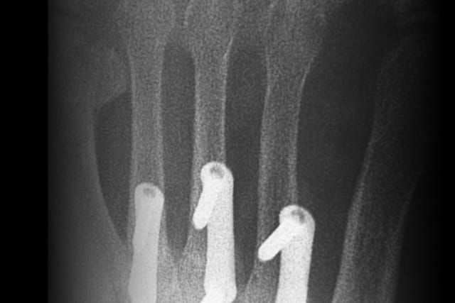 X-ray of a hand showing three surgical pins inserted into fractured bones of the fingers.