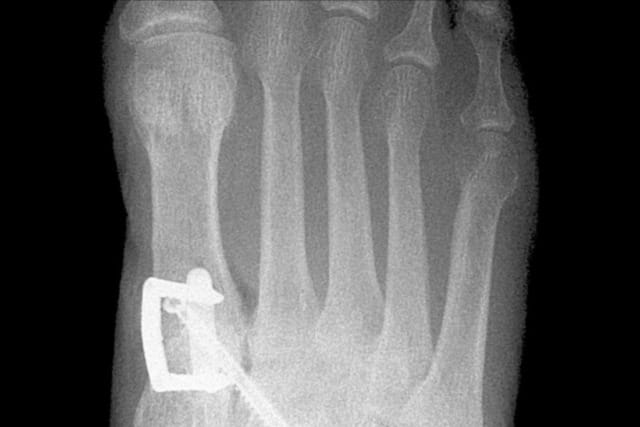 X-ray of a foot showing bones with a surgical plate and screws on the side of the first metatarsal.
