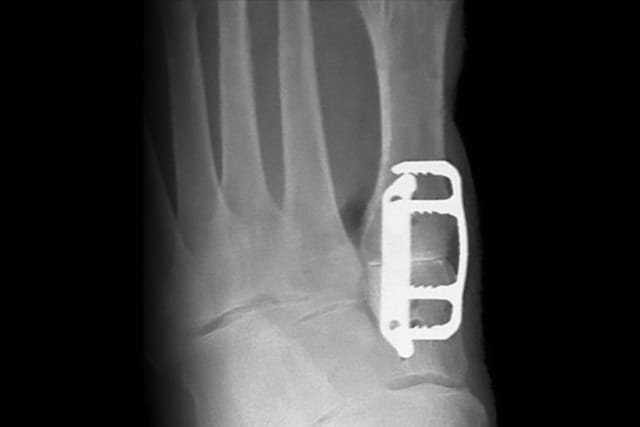 X-ray image of a broken ankle with a metal plate and screws used for surgical repair.