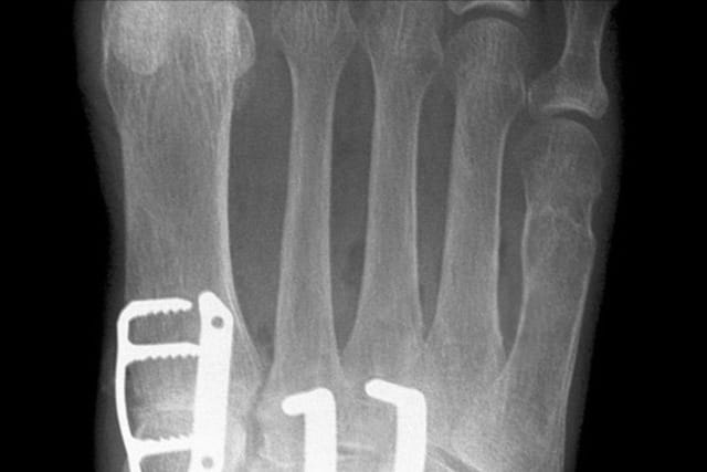 X-ray of a foot showing bones with surgical hardware, including plates and screws.
