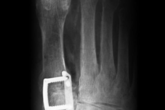 X-ray of a foot with surgical metal plate and screws fixing a broken bone near the toes.
