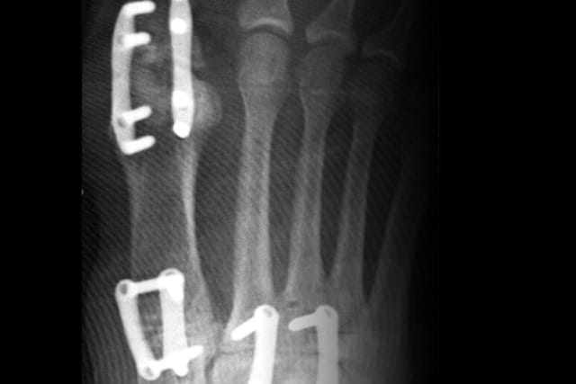 X-ray showing metal plates and screws in a foot with visible bones, indicating surgical intervention for fracture repair.
