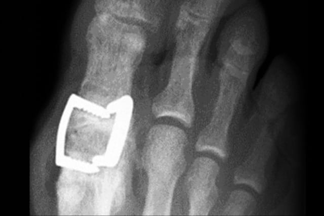X-ray of a foot showing a metal buckle around the big toe, highlighting bone structure and foreign object.