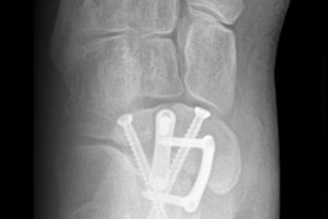 X-ray of a wrist with screws and a plate after orthopedic surgery, showing bone alignment and surgical hardware.