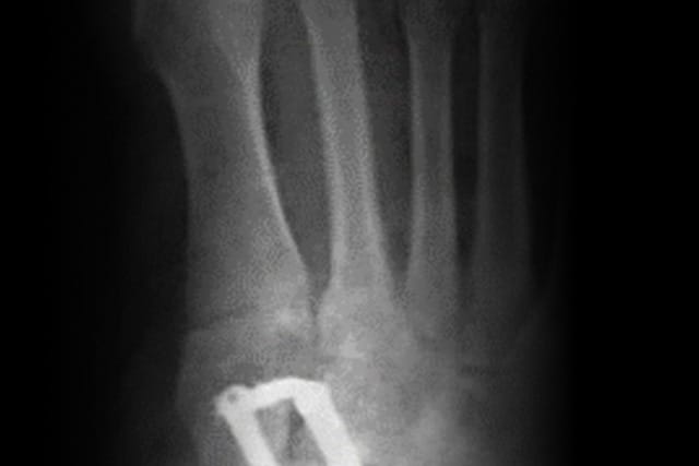 X-ray of a foot showing bones and a metal plate fixation on the lower left area, likely indicating a surgical repair.