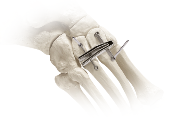 Surgical screws and plate on skeletal foot bones in medical illustration for orthopedic procedures.