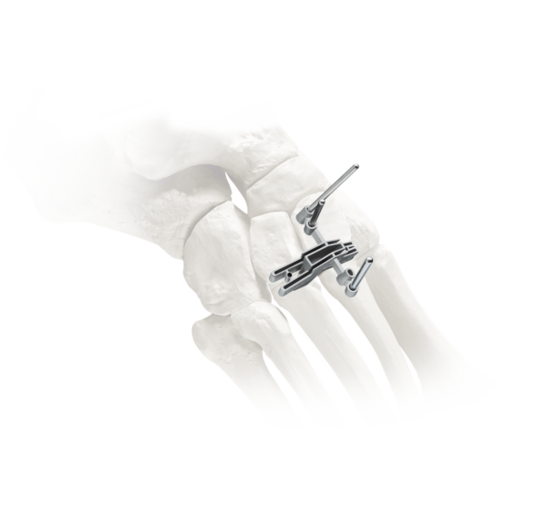 Illustration of a foot bone with surgical plates and screws for orthopedic fixation in a medical procedure.