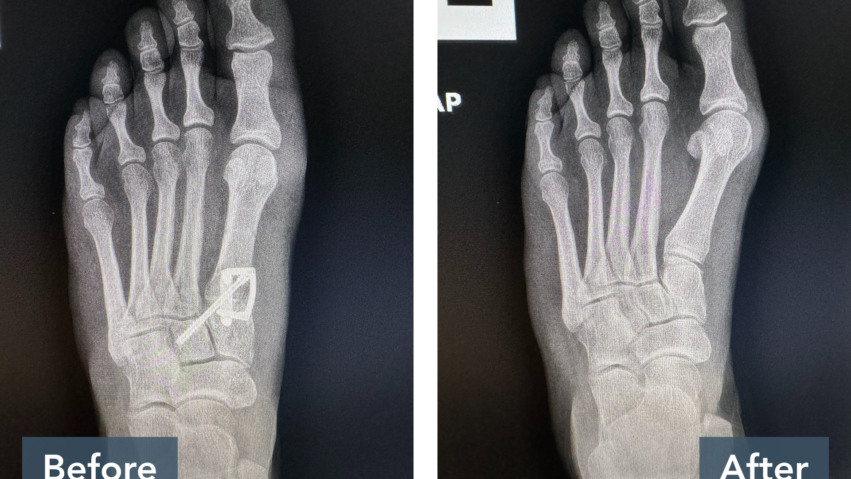Before and after X-ray images of foot, showing bone alignment changes and visible medical implant in the first image.