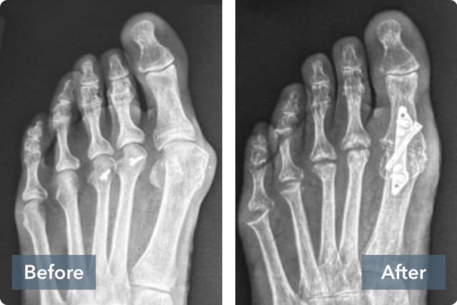 X-ray comparison of a foot before and after surgery with a metal plate installed.