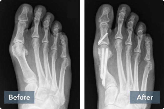 Before and after X-ray images of a foot showing bone realignment with surgical intervention.