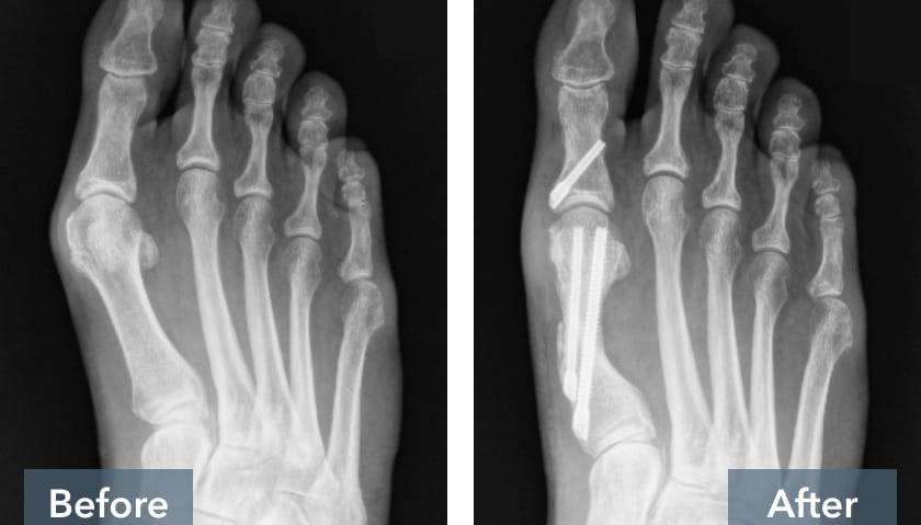 Before and after X-ray images of a foot showing bone realignment with surgical intervention.