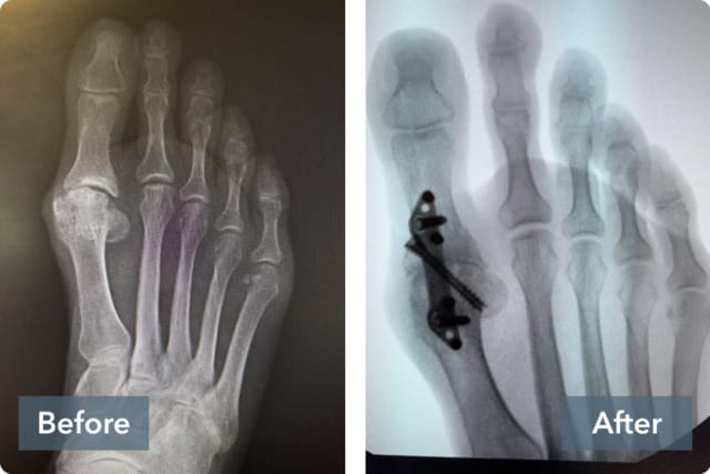 X-ray comparison showing a foot before and after surgery with screws and plates affixed to bones.