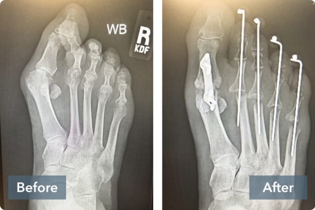 X-ray comparison of a foot before and after surgery with corrective hardware in place.