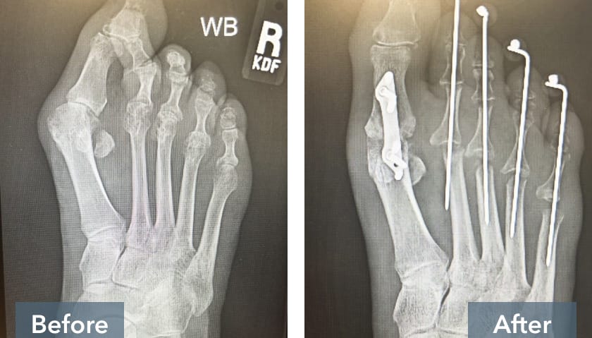 X-ray comparison of a foot before and after surgery with corrective hardware in place.