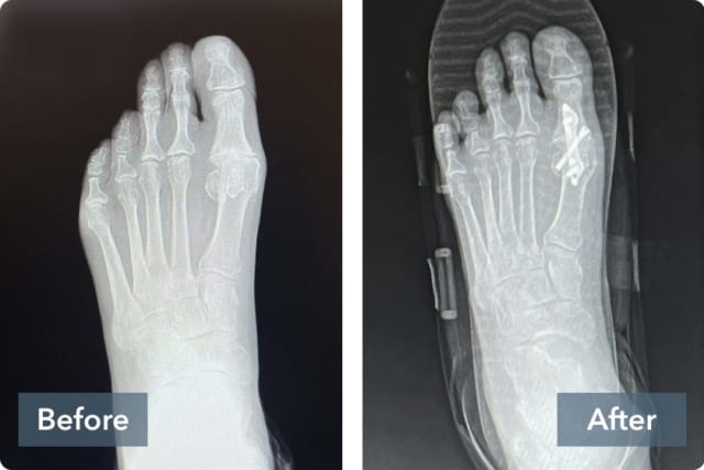 Side-by-side X-ray images labeled "Before" and "After," showing a foot with a severe bunion deformity (left) and the surgical correction (right) featuring realigned bones and Treace medical fixation plates and screws.
