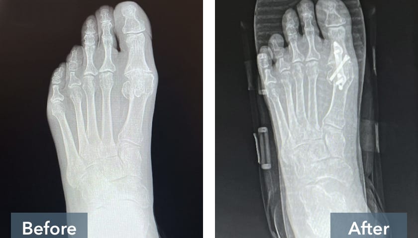 Side-by-side X-ray images labeled "Before" and "After," showing a foot with a severe bunion deformity (left) and the surgical correction (right) featuring realigned bones and Treace medical fixation plates and screws.