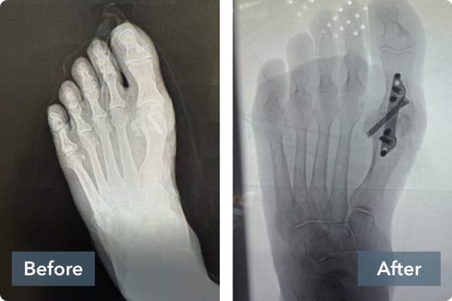 X-ray comparison of a foot before and after surgery, showing changes and hardware placement in the bones.