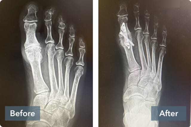 X-ray comparison of a foot before and after surgery showing pins inserted.