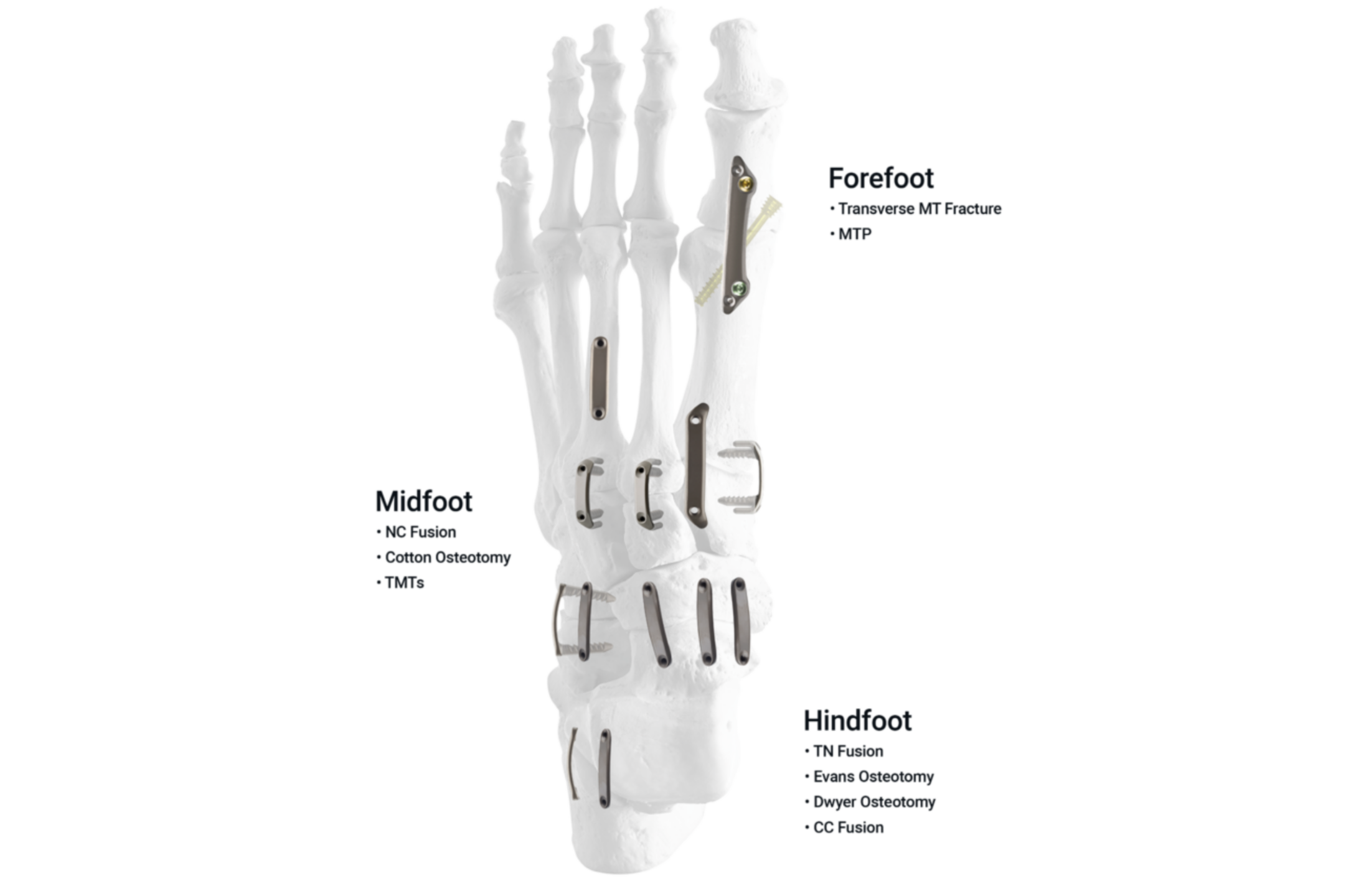 3D illustration of a human foot skeleton showing different bones and labeled sections: forefoot, midfoot, and hindfoot.