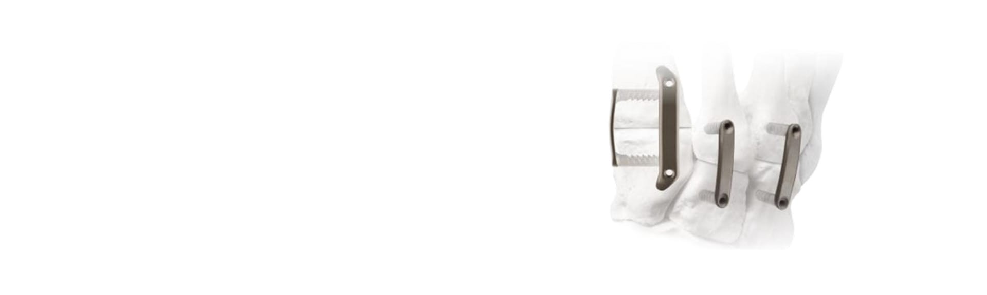 Foot with medical implants on a white background, showing screws and plate attached to the bones for stabilization.