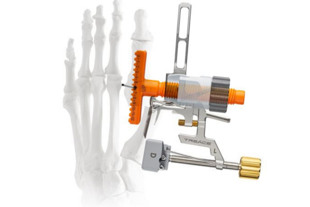medical device on skeletal foot model demonstrating surgical application