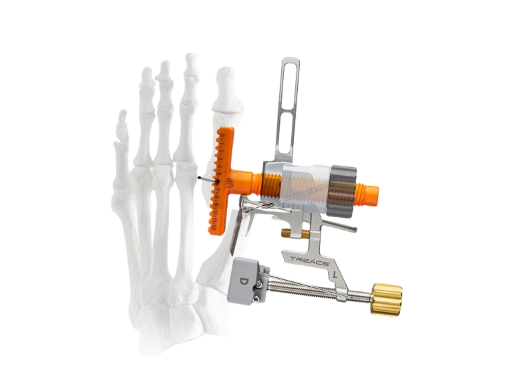 Medical device attached to a skeletal foot model, demonstrating orthopedic equipment used for surgical procedures.