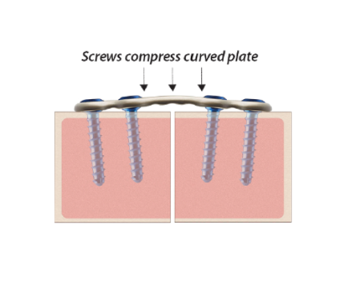Screws compressing a curved plate across two separate sections, illustrating mechanical force application.