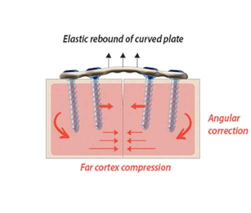 Illustration of a curved plate with screws showing elastic rebound, angular correction, and far cortex compression.