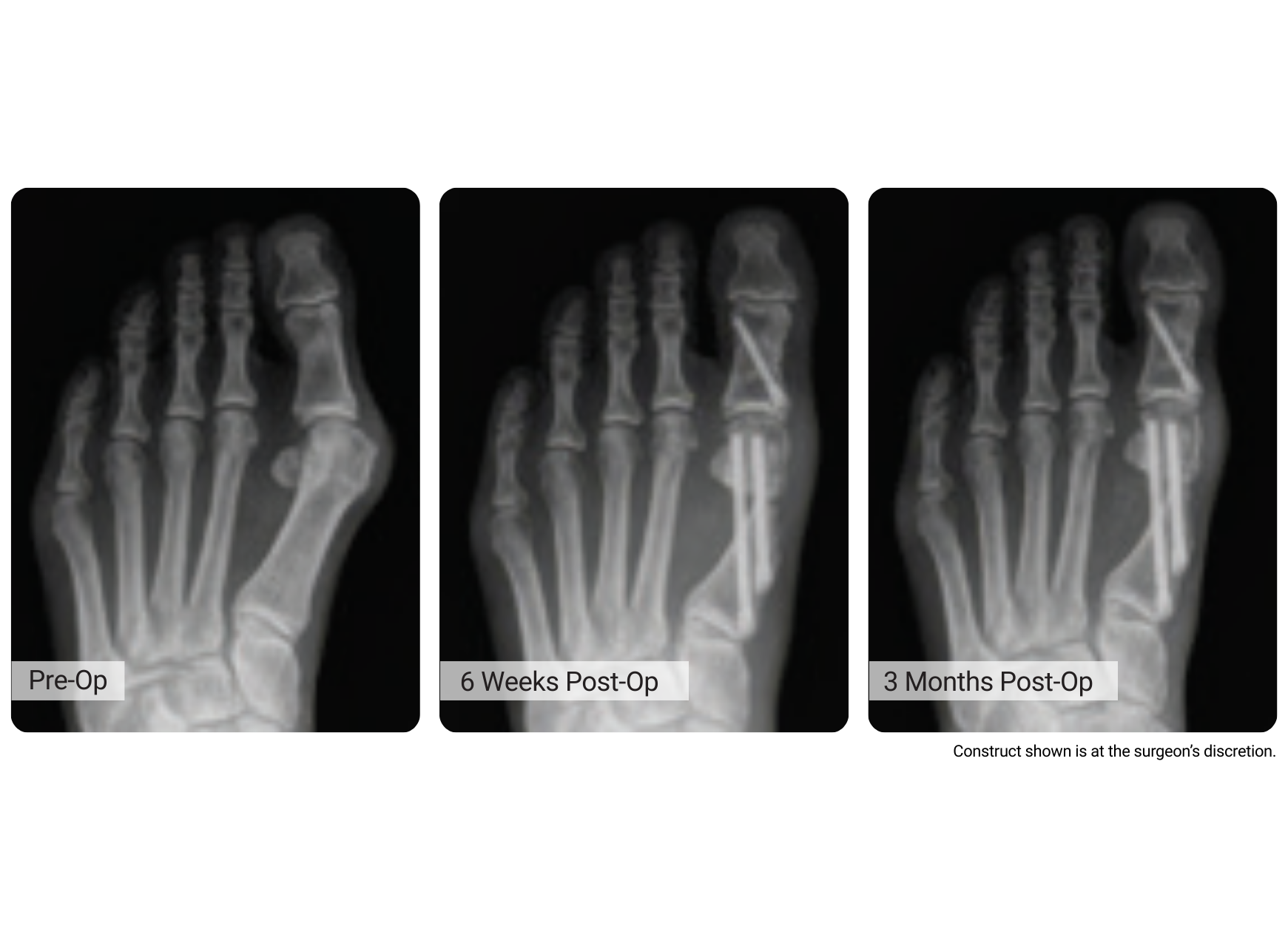 X-ray images of a foot: pre-operation, 6 weeks post-operation, and 3 months post-operation.