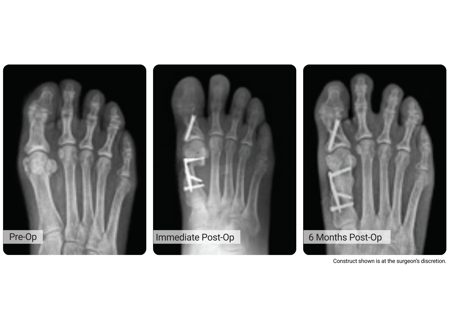 X-ray images of a foot before, immediately after, and six months after surgery with metal screws visible.