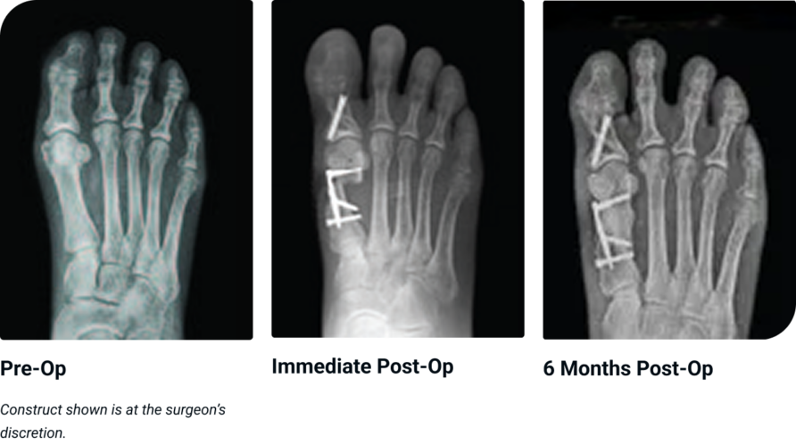 Three foot X-ray images showing pre-op, immediate post-op with screws, and 6 months post-op recovery stages.