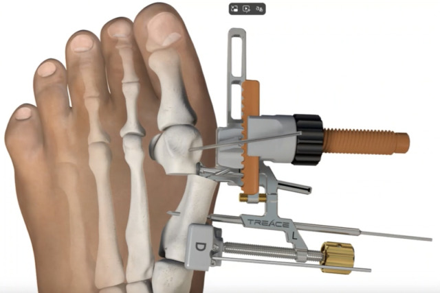 Illustration of a medical device fixing a bunion on the big toe with a detailed view of bones and surgical tools.
