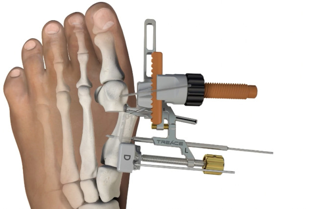 Diagram of foot with an orthopedic surgical device applied to toes and metatarsals, showing medical fixation procedure.