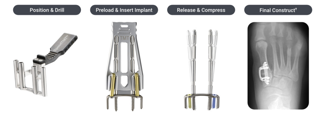 Series of images showing steps for implant procedure: Position & Drill, Preload & Insert Implant, Release & Compress, Final Construct.