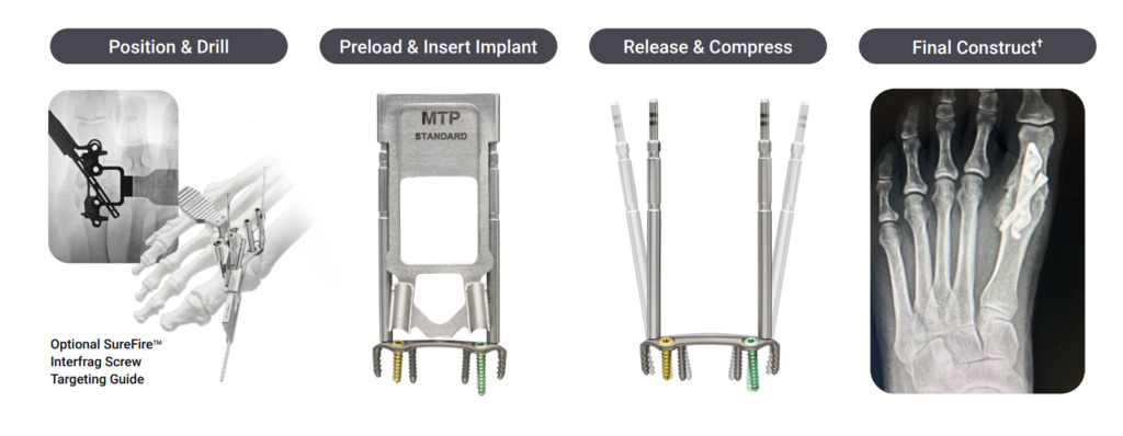 Four-step surgical implant procedure: position, preload implant, release and compress, final construct in X-ray view.