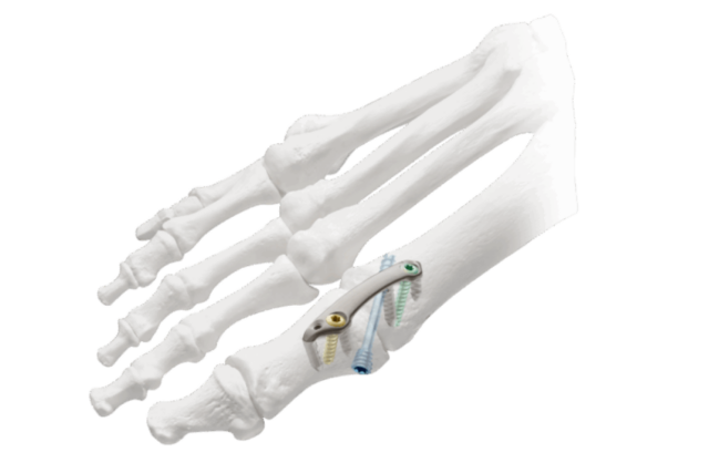 Illustration of a foot skeleton with orthopedic screws and plate on a bone.
