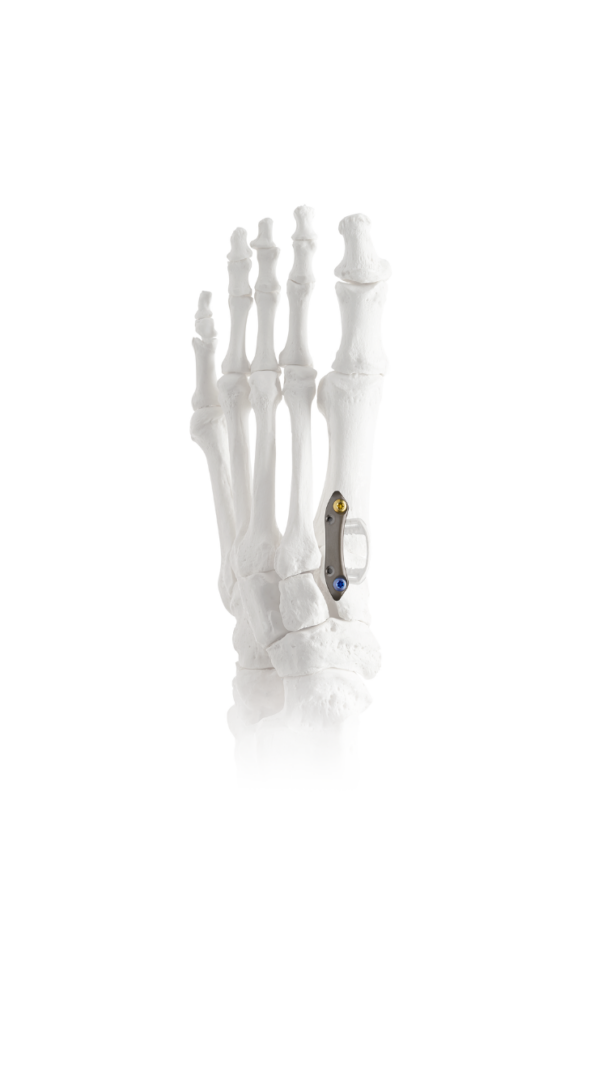 white skeletal foot model with metallic implant on toe, shown against a plain white background