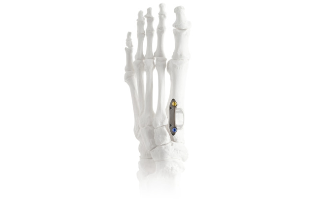 Anatomical model of a human foot skeleton with a metal orthopedic implant visible on one of the bones.