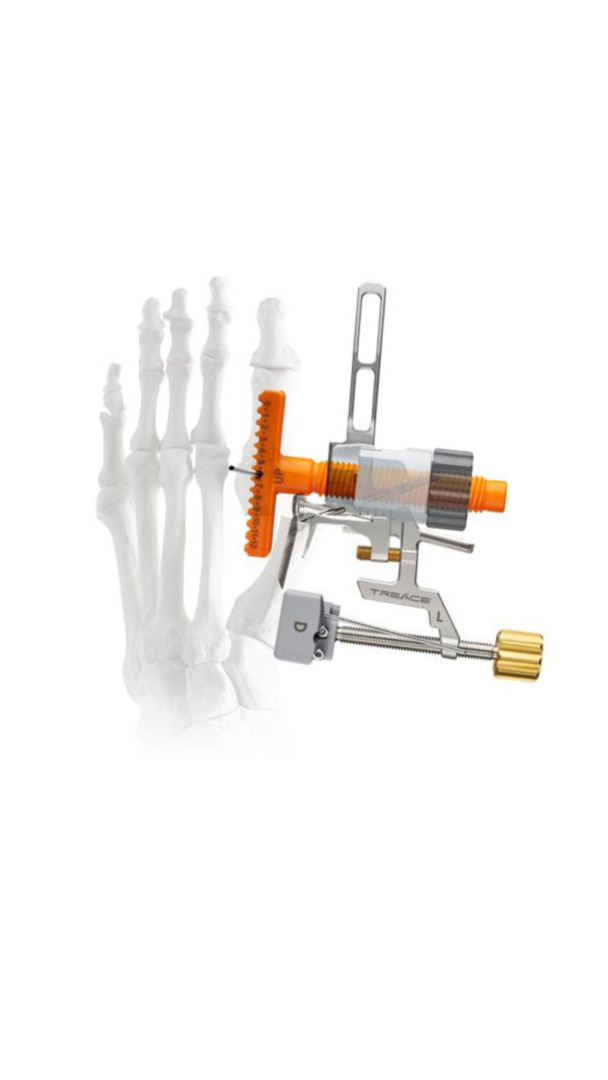 Medical device attached to a skeletal model of a human foot.