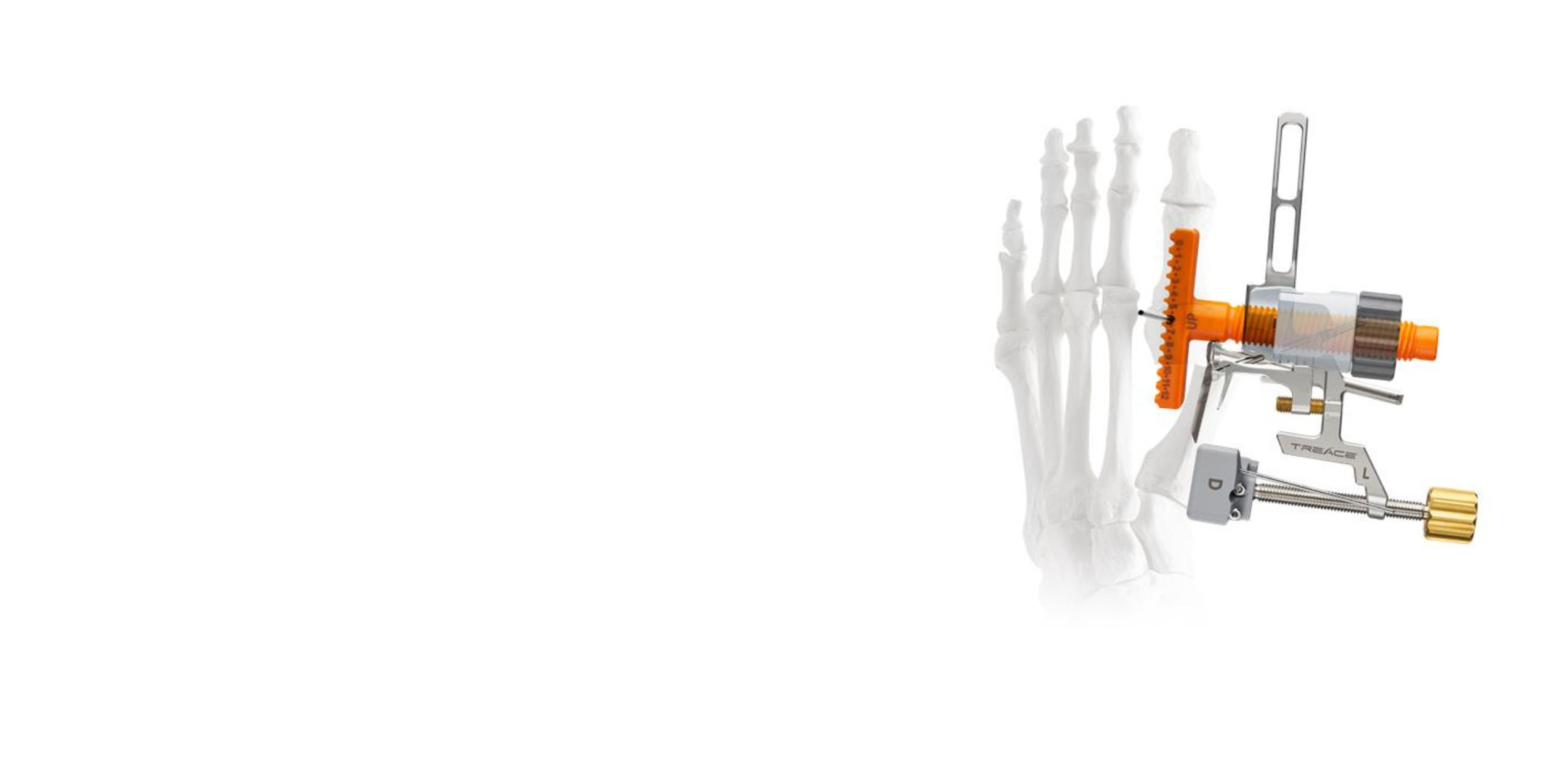 Skeletal foot with external fixation device attached, showing a medical procedure or orthopedic treatment.