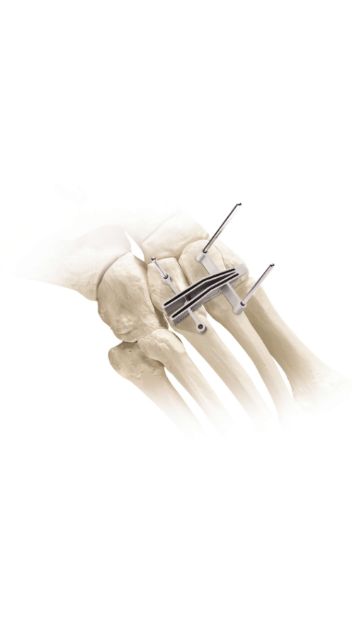 Illustration of a foot skeleton with orthopedic implant showing surgical hardware attached to bones.