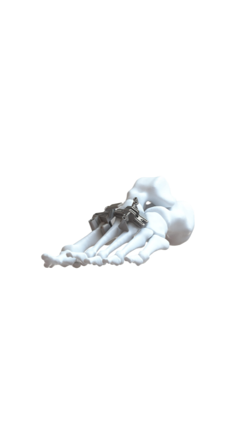 3D illustration of a human foot skeleton with metal plates and screws on the top, showing a surgical procedure.