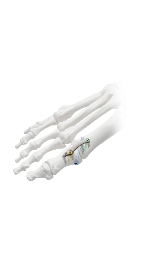 Illustration of a foot skeleton with a surgical device attached, showing bones and fixation hardware.