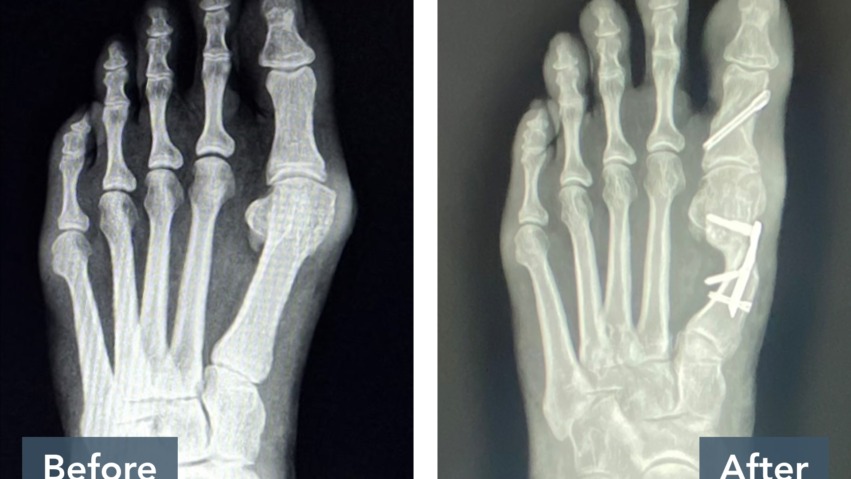 X-ray comparison of a foot before and after surgery, showing metal screws and bone alignment changes.
