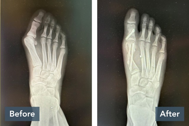 X-ray comparison of a foot showing a before image with fractures and an after image with surgical pins in place.