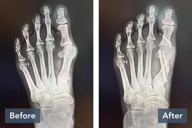 Before and after x-rays of a foot showing surgical correction of a bunion with improved alignment of the big toe.